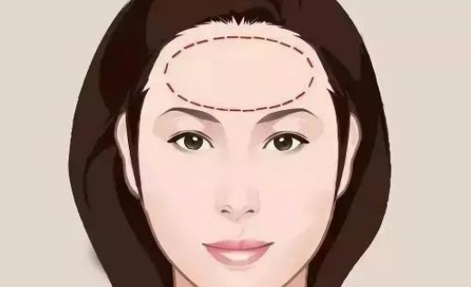 喬雅登雅致適合做哪些部位？皺紋拜拜|玻尿酸去抬頭紋案例附上