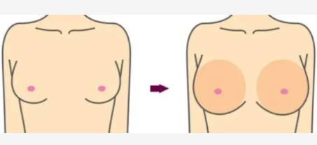 隆胸5 (3).png 隆胸5 (3).png