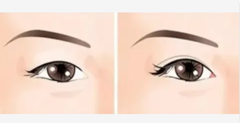 雙眼皮7 (2).png 雙眼皮7 (2).png