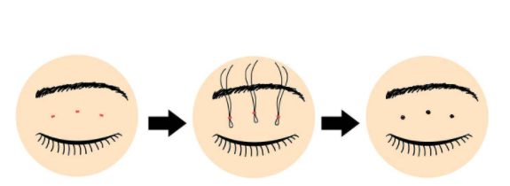 雙眼皮16.png 雙眼皮16.png