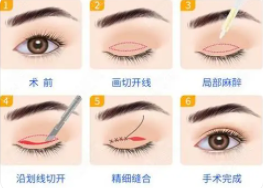 雙眼皮12.png 雙眼皮12.png