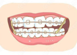 牙齒矯正5.png 牙齒矯正5.png