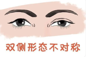 雙眼皮5 (2).png 雙眼皮5 (2).png