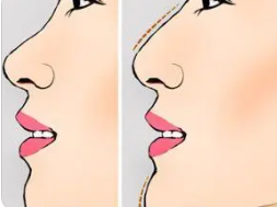 隆鼻1.png 隆鼻1.png